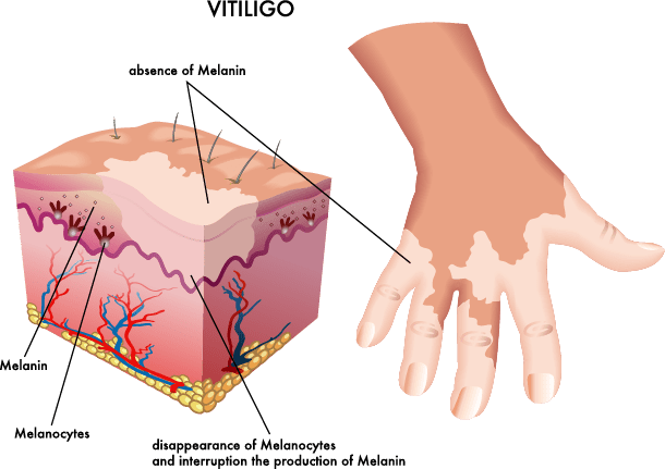 Vitiligine